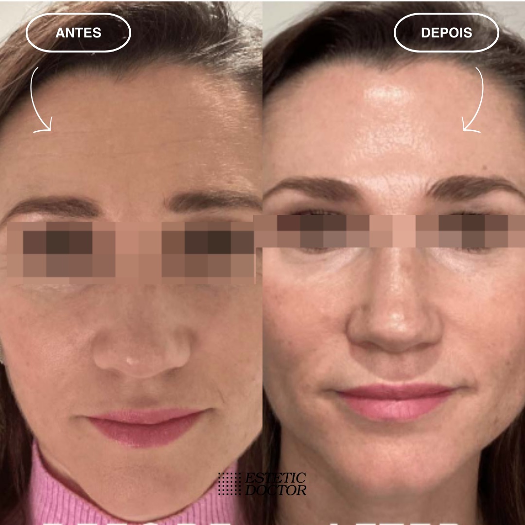 Resultado BioRegenerador de Colágeno + Toxina Preventivo